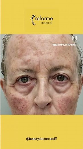 What's a liquid facelift