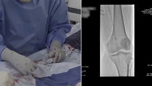 PTAB with the DETOUR System Procedure (Complex PAD Treatment)