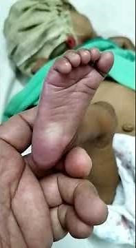 Delayed Capillary Refill Time 7 sec in 2 mn old infant 105.6*F, cutis mormorata cold extremities.