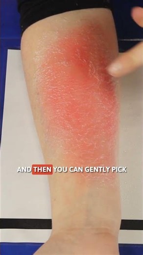 TraumaSim #shorts | HOW TO: DermaBurn (Mid Dermal)