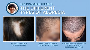 Different Types of Alopecia