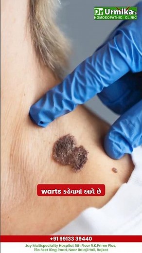 What are warts and why do they happen? 🧐🧬