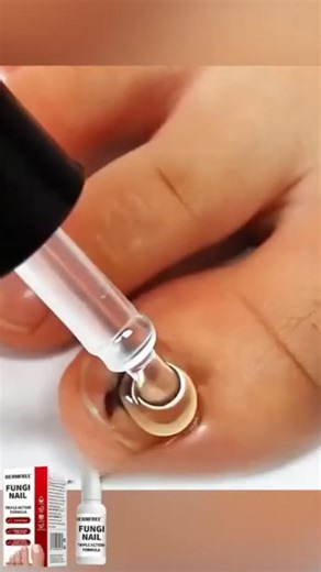 🦶TO naprawdę działa na grzybicę paznokci!✨ ✅ Silna formuła zwalcza uporczywą grzybicę paznokci 💅 Zapewnia zdrowe, jasne i estetyczne paznokcie 🌿 Delikatny, ale skuteczny dzięki naturalnym składnikom 🏠 Łatwy w użyciu w domu, widoczne efekty szybko Zamów dziś z rabatem! ->https://bymilenakowalski.com/products/mycoclear-ultra-serum-pozbadz-sie-grzybicy-paznokci-w-2-tygodnie | Bymilenakowalski