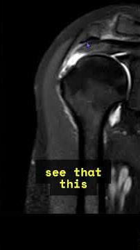 “Supraspinatus Tear on MRI? Don’t Forget to Report Tendinosis of Torn Ends”#msk#mri#pain#shoulder
