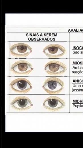 Pupilas mioticas e anisocoria o que significa? #enfermagem #medicina #tecnicosdeenfermagem