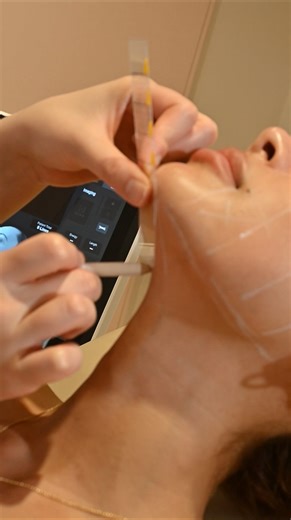 ✨ A lifted look — without the lift ✨ Introducing Ultherapy Prime, the gold standard in non-surgical lifting 💎 Tighten, contour, and refine your features naturally — with zero downtime. Think of it as your quiet luxury facial upgrade: subtle, sculpted, and effortlessly elevated. Take advantage of our biggest promo of the year Prices starting from $1700, the more you buy the more you save, prices go as low as $1500 per treatment. To get your Ultherapy prime session, DM to book #miyoungs #koreansk