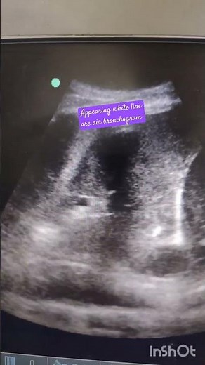 Air bronchogram in lung ultrasound