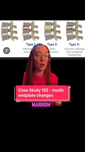 Understanding Modic Endplate Changes in Degenerative Disc Disease