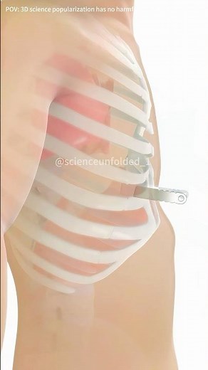 Pectus Excavatum And Nuss Procedure (3D Animation)#pectusexcavatum? #pectusexvactum #3danimation