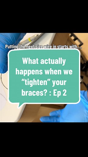 Tightening Braces: How the New Archwire Is Measured and Placed