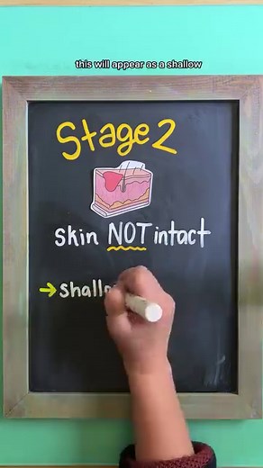🩹 PRESSURE INJURY STAGES follow @nursewellversed for visual nursing education A pressure injury is a breakdown of skin integrity due to unrelieved pressure. There are different stages of pressure injuries that are classified based on their severity and progression. 1️⃣ Stage 1 →Non-blanchable redness →Skin is NOT open but appears swollen and irritated 2️⃣ Stage 2 →Skin NOT intact →Shallow, open ulcer with partial thickness skin loss →NO fat or muscle exposed 3️⃣ Stage 3 →Full thickness skin los