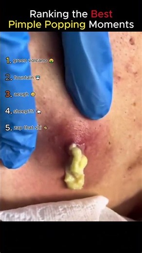Ranking Best Pimple Popping Moments 💥#satisfying #rankings #shorts