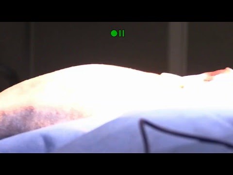 Sacroiliac luxation repair using fluoroscopic guidance