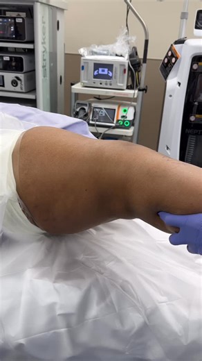Amit Momaya, MD on Instagram: "The exam under anesthesia is important to assess a Lachman test and a pivot shift test when surgically managing an ACL tear. A high grade pivot shift may need an LET to help stabilize the knee and decrease postoperative retear or pivoting. #sportsmedicine #orthopedicsurgery"