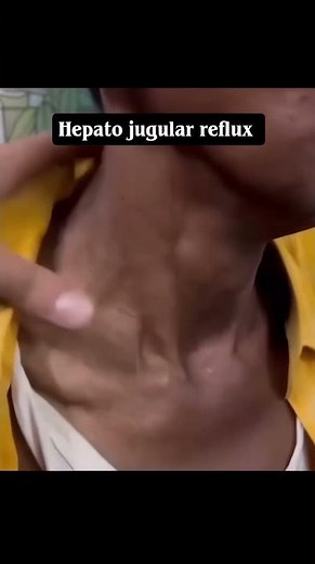 What Your Neck Veins Can Tell You About Your Heart (Hepatojugular Reflex)