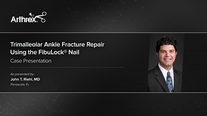 Trimalleolar Ankle Fracture Repair Using the FibuLock® Nail