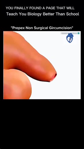 BIOLOGY | MEDICAL | HEALTH on Instagram: "“Prepex Non-Surgical Circumcision” 🧠⚕️ It sounds shocking at first… but this is real medical science — no surgery, no blades 😳 👨‍⚕️ What is Prepex? Prepex is a non-surgical circumcision device that is placed on the foreskin. 🧬 How does it work? • The device cuts off blood supply to the foreskin • Within a few days, the foreskin naturally dries out (necrosis) • A doctor safely removes it without cutting • No stitches and no operating theatre required 