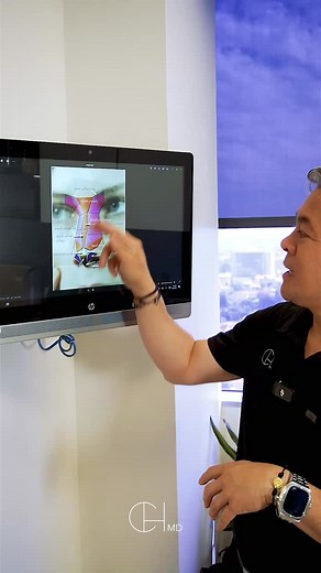 Here’s another way to visualize the underlying bone and cartilage structures of the nose. This concept breaks the nose down into different bony and cartilaginous polygons. By carefully adjusting these subtle shapes, we can control how light and shadow fall on the nose from the outside in order to create the definition and balance we want to see. It’s all about understanding the anatomy behind beautiful aesthetics. When choosing a nose surgeon, be sure to see someone who specializes in these nuan