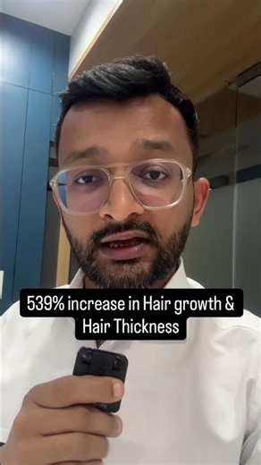 Minoxidil se Aazadi Mil Jayegi !!!!