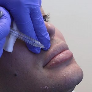 Male Lip Enhancement | Contouring and Volumizing