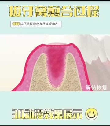 拔牙后，牙窝的自我愈合过程！太细节了