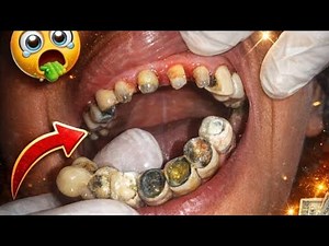 Broken Old Dental Bridge Removed & Replaced! Extreme Smile Transformation | Dental Crowns