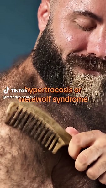 Werewolf Syndrome: 48 Chromosomes and More