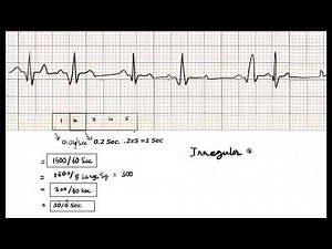 Calculation of Heart Rate & Rhythm basis on ECG recording