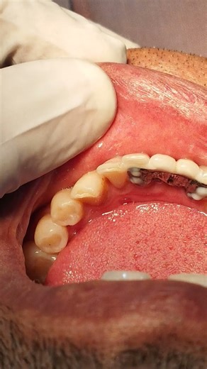 Missing Teeth? Affordable Solutions that ACTUALLY WORK