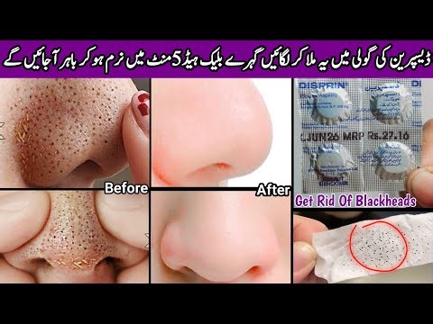 How To Remove BLACKHEADS Permanently From Nose & Face Instantly 💯| Naturally At Home | No Whiteheads