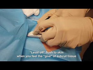 Contraceptive Implant (Implanon) Insertion and Removal Tutorial (GP Lyf Hacks)