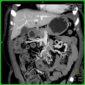 carcinoid tumor duodenum 3 | CTisus: Cutting edge information on body CT (Computed tomography). | Facebook