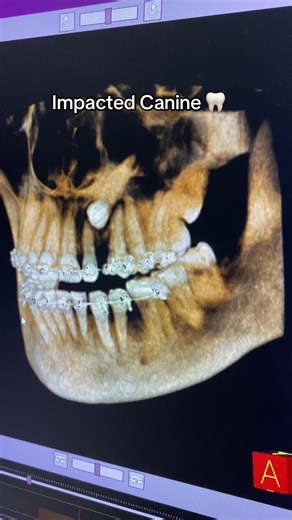Impacted Canine Surgery Insights 🦷