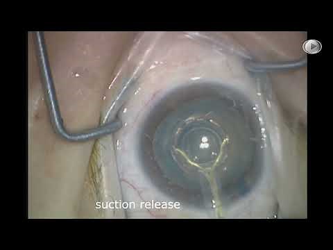 Dr. David Chang: ZEPTO® Capsulotomy in a Mature White Cataract