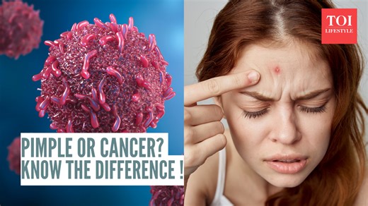 Basal cell skin cancer: Dermatologist explains how it can be mistaken for a harmless pimple and shares how to identify the difference