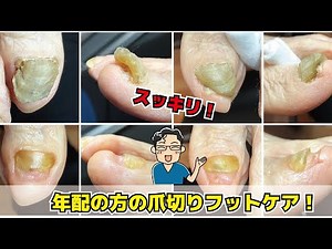 爪が分厚くて切れない！【高齢者の爪切りフットケア】