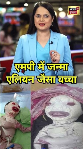 MP में जन्मा Alien जैसा बच्चा| Rewa | Viral | Infant #shorts