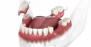 Removable partial denture, mandibular prosthesis