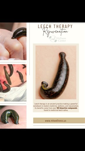 MK Wellness Center on Instagram: "🩸 Leech Therapy (Hirudotherapy): Ancient Healing, Modern Science Leech therapy is an ancient practice making a powerful comeback in modern medicine, wellness, and rejuvenation. Its benefits come from over 100 bioactive compounds found in medicinal leech saliva. 🔬 Why It Works ✔️ Hirudin – a natural anticoagulant that improves blood flow ✔️ Anti-inflammatory agents – help reduce pain and swelling ✔️ Vasodilators – enhance circulation and oxygen delivery ✔️ Natu
