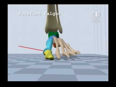 Forefoot Valgus Gait
