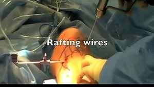 Arthroscopy assisted percutaneous reduction and fixation of tibial plateau fracture using inflation plasty