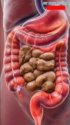 Severe Constipation in Intestines | Hard Stool Blockage Explained