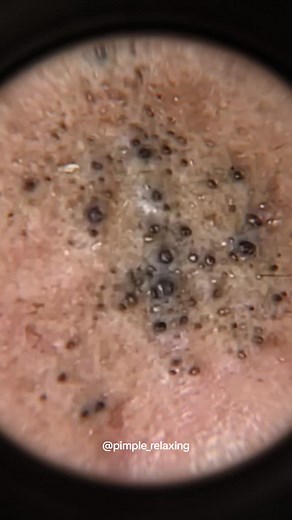 Time to relax 💆🏼‍♀️ #blackheads #supersatisfying #extractionsatisfaciton #pimplepop