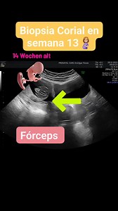 Biopsia Corial Transabdominal: Esta es una prueba de diagnóstico prenatal e implica el examen de las vellosidades coriónicas (tejido de la placenta). Tanto el bebé como la placenta provienen del mismo material genético, por lo que los cromosomas presentes en las células de la placenta son los mismos que los del bebé. ¿CUÁNDO SE REALIZA ESTA PRUEBA? La prueba se realiza a partir de las 11 semanas de gestación, con una edad gestacional máxima propuesta de 15 semanas. ¿CÓMO SE HACE LA BIOPSIA? Bajo