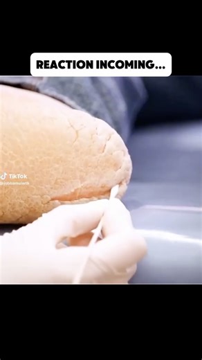 Feet First Clinic on Instagram: "Wow. Hey Foot Fam, let’s talk about this. 👣 Thick, cracked calluses usually come from two things: too much pressure and not enough moisture. High activity, poor foot mechanics, tight shoes, or genetics can all cause calluses to build up faster. When skin is dry, it cannot flex properly, which leads to cracking. To help prevent this, reduce pressure on the area and moisturize daily with a urea based foot cream. If calluses keep coming back or become painful, it i