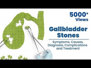 Gallbladder stones: Symptoms, Causes, Diagnosis, Complications and Treatment.