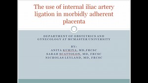The Use of Internal Iliac Artery Ligation in Morbidly Adherent Placenta