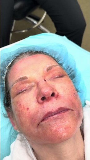 Contour TRL Before and After