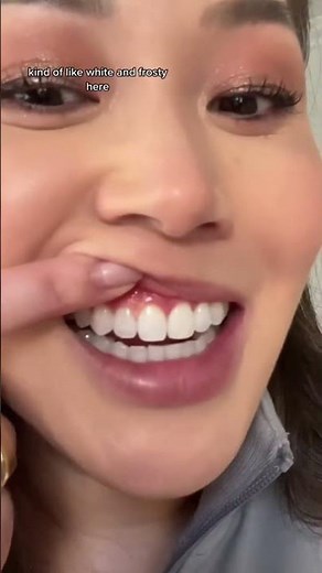 I accidentally burned my gums with teeth whitening chemicals. #teethwhitening #whiteteeth #dentist