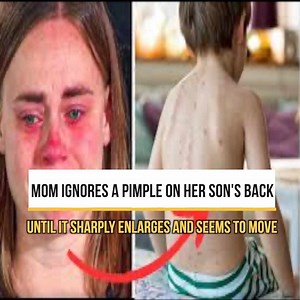 Mom Ignores A Pimple On Her Son's Back Until It Sharply Enlarges And Seems To Move | Trending Videos In The World